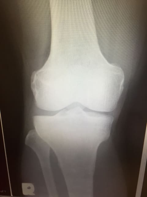 膝関節のレントゲン写真
