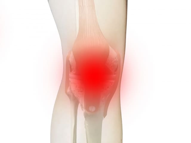 膝関節の炎症のイラスト