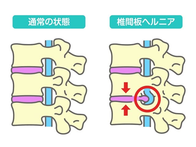 椎間板性腰痛のイラスト